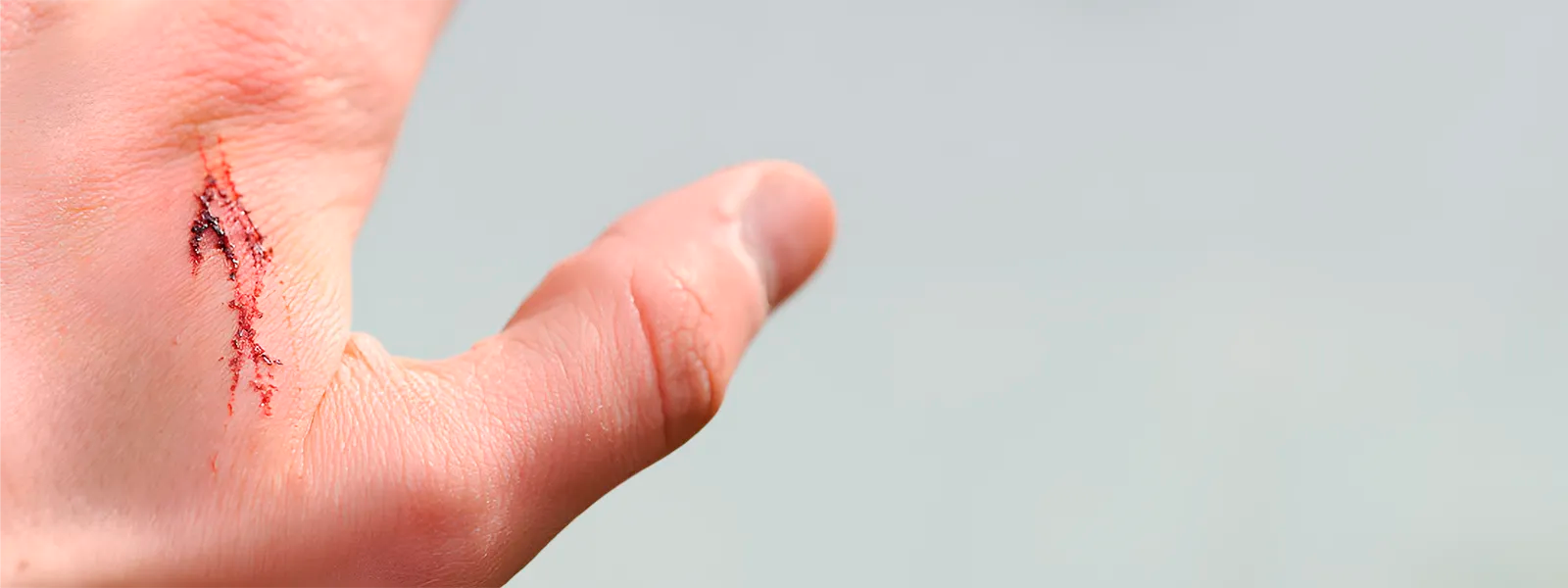 How To Prevent A Scar