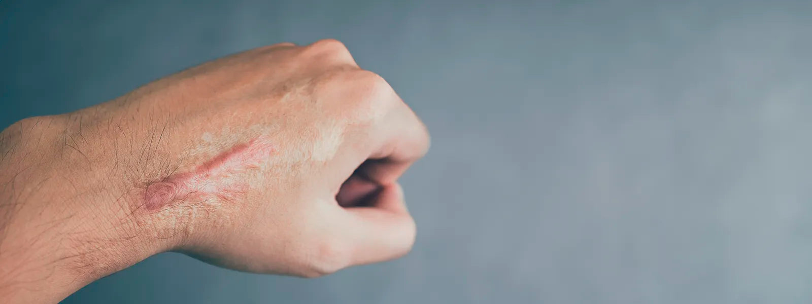 How to Care for Young Scars: A Comprehensive Guide