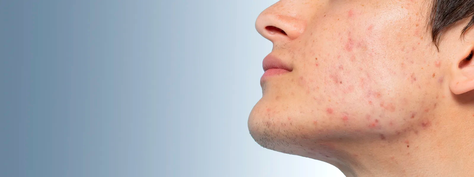 How Do Blemishes Form?