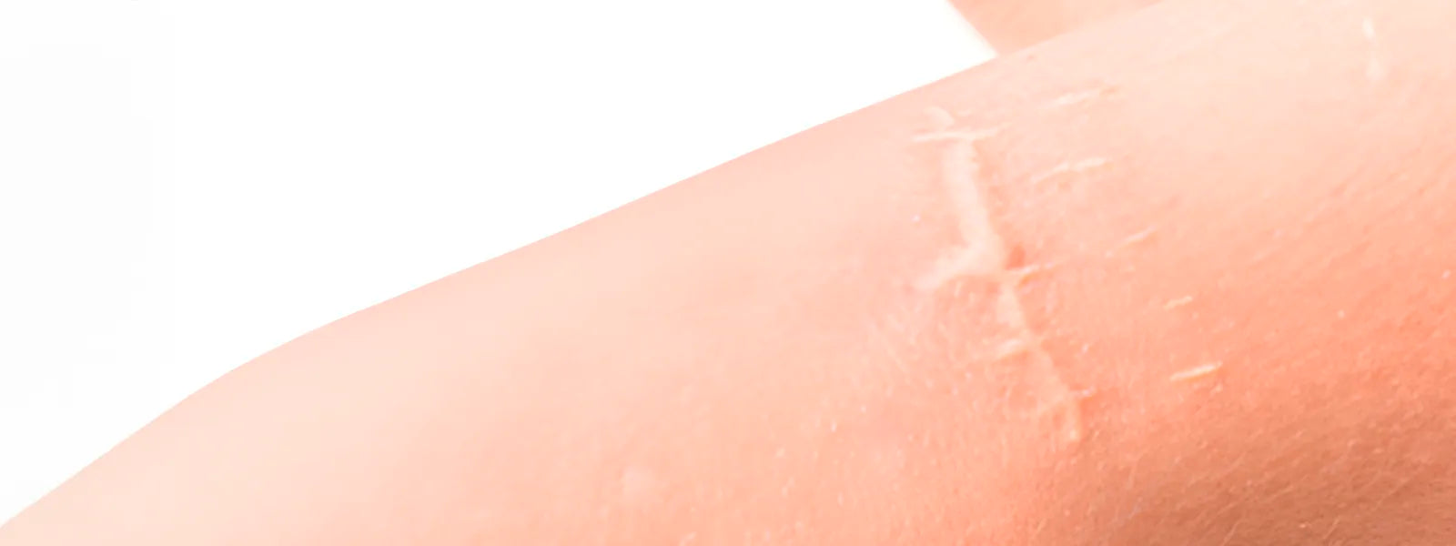 Se Scars Scars - RecoverX Skincare