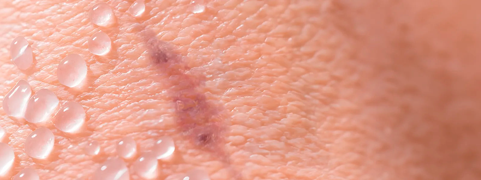 Silicone Based Scar Treatments: An Overview